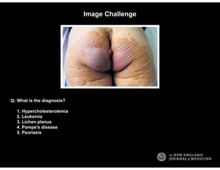 Image Challenge
What is the diagnosis?
1. Hypercholesterolemia
2. Leukemia
3. Lichen planus
4. Pompe's disease
5. Psoriasi...