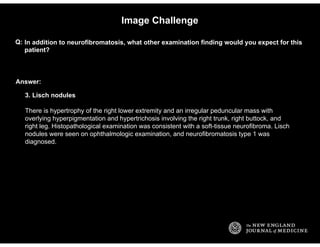 Answer:
Image Challenge
In addition to neurofibromatosis, what other examination finding would you expect for this
patient...
