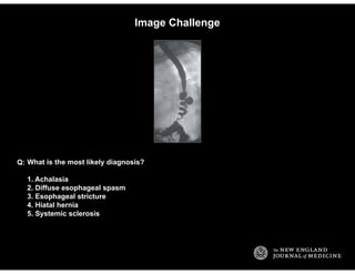 Image Challenge
What is the most likely diagnosis?
1. Achalasia
2. Diffuse esophageal spasm
3. Esophageal stricture
4. Hia...
