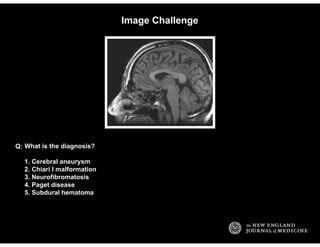 Image Challenge
What is the diagnosis?
1. Cerebral aneurysm
2. Chiari I malformation
3. Neurofibromatosis
4. Paget disease...