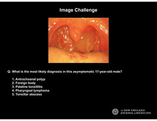 Image Challenge
What is the most likely diagnosis in this asymptomatic 17-year-old male?
1. Antrochoanal polyp
2. Foreign ...