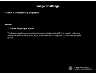 Answer:
Image Challenge
What is the most likely diagnosis?Q:
2. Diffuse esophageal spasm
The barium-swallow examination sh...