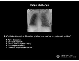 Image Challenge
What is the diagnosis in this patient who had been involved in a motorcycle accident?
1. Aortic dissection...
