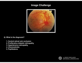 Image Challenge
What is the diagnosis?
1. Central retinal vein occlusion
2. Profilerative diabetic retinopathy
3. Hyperten...