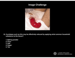 Image Challenge
A prolapse such as this may be effectively reduced by applying what common household
substance to the tiss...