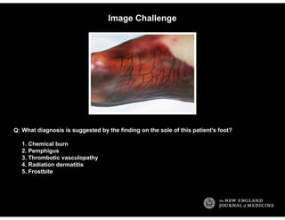 Image Challenge
What diagnosis is suggested by the finding on the sole of this patient's foot?
1. Chemical burn
2. Pemphig...