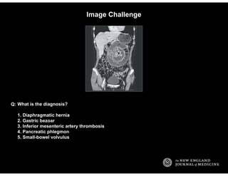 Image Challenge
What is the diagnosis?
1. Diaphragmatic hernia
2. Gastric bezoar
3. Inferior mesenteric artery thrombosis
...