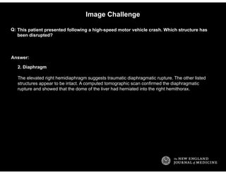 Answer:
Image Challenge
This patient presented following a high-speed motor vehicle crash. Which structure has
been disrup...