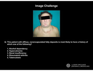 Image Challenge
This patient with diffuse, nonencapsulated fatty deposits is most likely to have a history of
which one of...