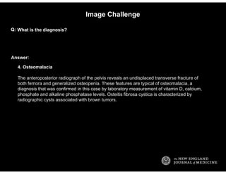 Answer:
Image Challenge
What is the diagnosis?Q:
4. Osteomalacia
The anteroposterior radiograph of the pelvis reveals an u...