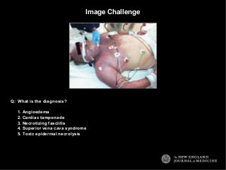 Image Challenge 
What is the diagnosis? 
1. Angioedema 
2. Cardiac tamponade 
3. Necrotizing fasciitis 
4. Superior vena cava syndrome 
5. Toxic epidermal necrolysis 
Q: 
 