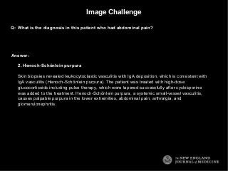 Image Challenge
Q: What is the diagnosis in this patient who had abdominal pain?

Answer:
2. Henoch-Schönlein purpura
Skin biopsies revealed leukocytoclastic vasculitis with IgA deposition, which is consistent with
IgA vasculitis (Henoch-Schönlein purpura). The patient was treated with high-dose
glucocorticoids including pulse therapy, which were tapered successfully after cyclosporine
was added to the treatment. Henoch-Schönlein purpura, a systemic small-vessel vasculitis,
causes palpable purpura in the lower extremities, abdominal pain, arthralgia, and
glomerulonephritis.

 