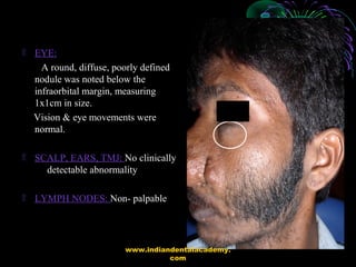 ۩ EYE:
A round, diffuse, poorly defined
nodule was noted below the
infraorbital margin, measuring
1x1cm in size.
Vision & ...