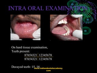 INTRA ORAL EXAMINATION
On hard tissue examination,
Teeth present:
87654321 12345678
87654321 12345678
Decayed teeth: 15, 1...