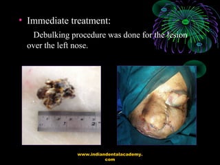 • Immediate treatment:
Debulking procedure was done for the lesion
over the left nose.
www.indiandentalacademy.
com
 