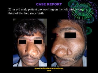22 yr old male patient c/o swelling on the left middle one
third of the face since birth.
CASE REPORT
www.indiandentalacad...