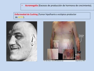 • Acromegalia (Excesos de producción de hormona de crecimiento).
Enfermedad de Cushing (Tumor hipofisario o ectópico productor
de ).
 