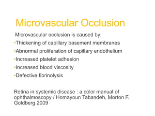 Microvascular Occlusion
Microvascular occlusion is caused by:
•Thickening of capillary basement membranes
•Abnormal proliferation of capillary endothelium
•Increased platelet adhesion
•Increased blood viscosity
•Defective fibrinolysis
Retina in systemic disease : a color manual of
ophthalmoscopy / Homayoun Tabandeh, Morton F.
Goldberg 2009
 