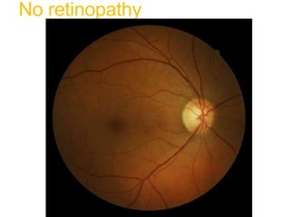 No retinopathy
 