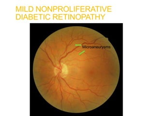 MILD NONPROLIFERATIVE
DIABETIC RETINOPATHY
Microaneurysms
 