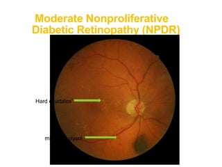 Moderate Nonproliferative
Diabetic Retinopathy (NPDR)
Hard exudates
microaneurysm
 