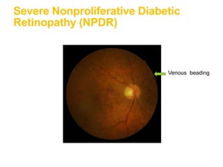 Severe Nonproliferative Diabetic
Retinopathy (NPDR)
Venous beading
 