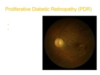 Proliferative Diabetic Retinopathy (PDR)
Characteristics
• Neovascularization
• Vitreous/preretinal
hemorrhage
 