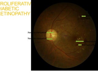 PROLIFERATIVE
DIABETIC
RETINOPATHY
Neovascularization
Neovascularization
Hard exudate
Cotton-wool
spot
Blot hemorrhage
 