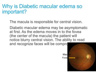 Why is Diabetic macular edema so
important?
The macula is responsible for central vision.
Diabetic macular edema may be asymptomatic
at first. As the edema moves in to the fovea
(the center of the macula) the patient will
notice blurry central vision. The ability to read
and recognize faces will be compromised.
Macula
Fovea
 