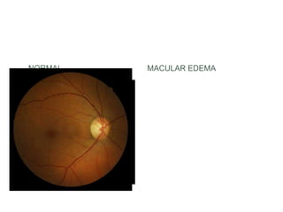 NORMAL MACULAR EDEMA
 
