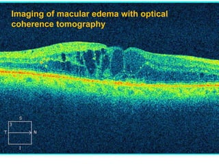 Imaging of macular edema with optical
coherence tomography
 
