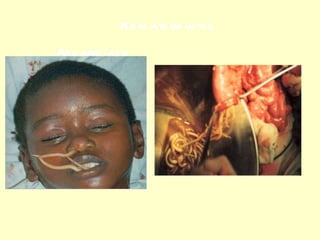 Nematelmintos Ascaridíase 