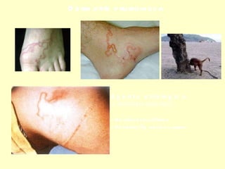 Dermatite pruriginosa Agente etiológico :  Ancylostoma brasiliensis - Região subcutânea - Penetração ativa da larva 