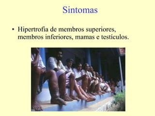 Sintomas Hipertrofia de membros superiores, membros inferiores, mamas e testículos. 