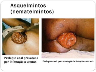 Asquelmintos (nematelmintos) Prolapso anal provocado por infestação a vermes Prolapso anal  provocado por infestação a vermes 