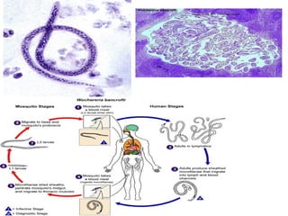 Asquelmintos (nematelmintos) Wuchereria bancrofti  (filária - “elefantíase”) 