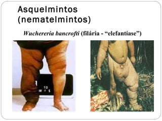 Asquelmintos (nematelmintos) Wuchereria bancrofti  (filária - “elefantíase”) 