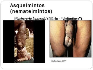 Asquelmintos (nematelmintos) Wuchereria bancrofti  (filária - “elefantíase”) 