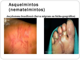 Asquelmintos (nematelmintos) Ancylostoma brasiliensis  (larva migrans ou bicho-geográfico) 