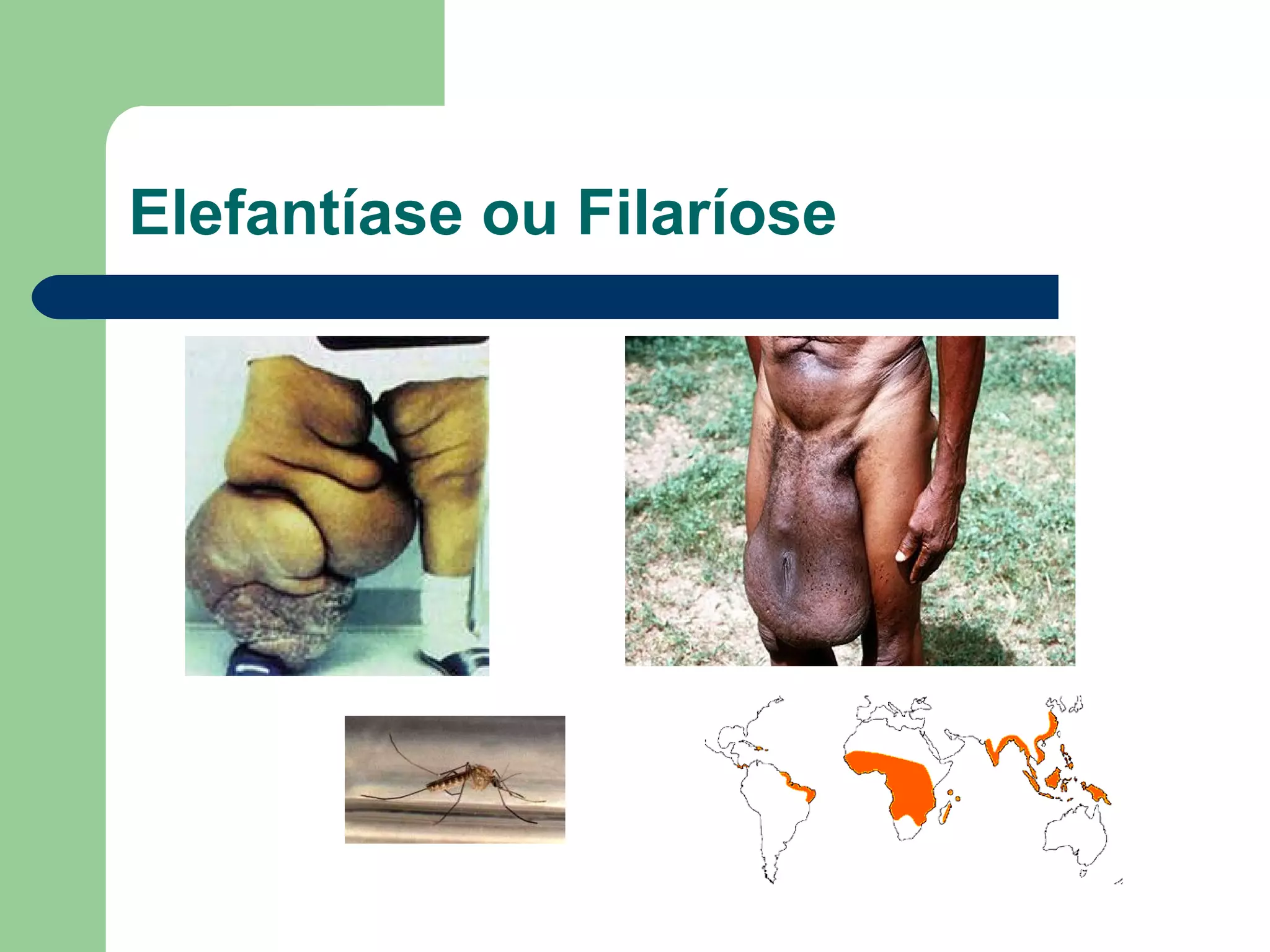 Elefantíase ou Filaríose