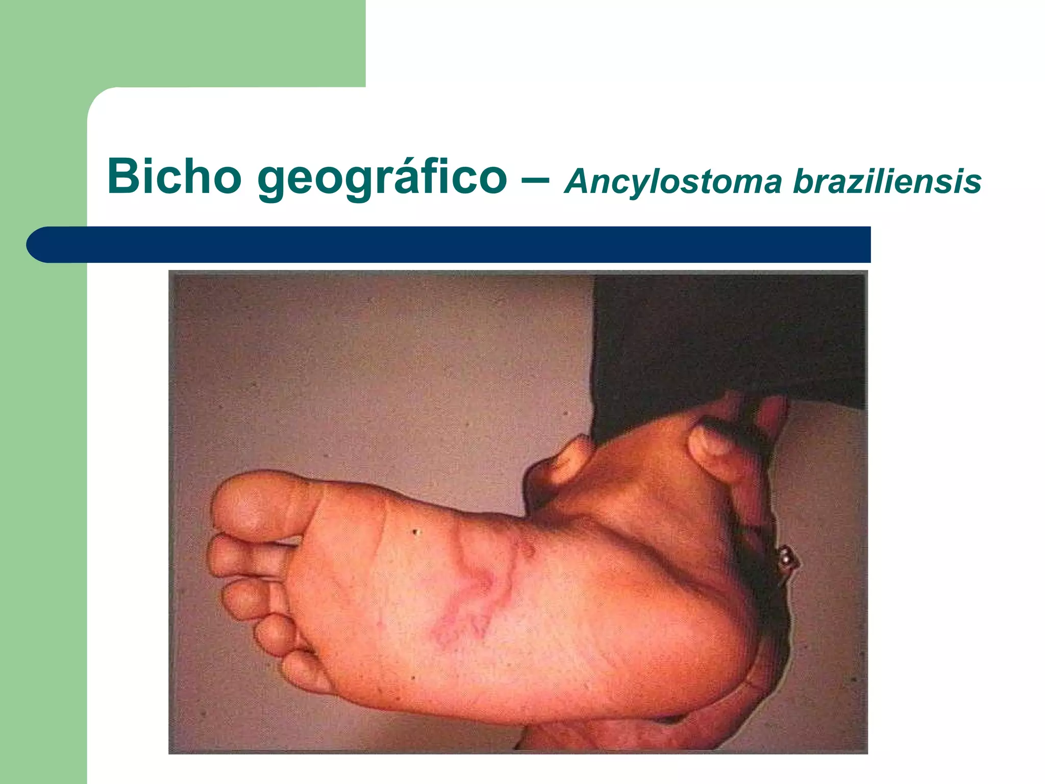 Bicho geográfico – Ancylostoma braziliensis