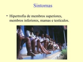 Sintomas
• Hipertrofia de membros superiores,
  membros inferiores, mamas e testículos.
 