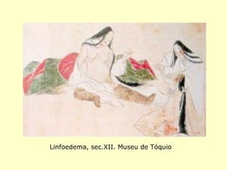 Linfoedema, sec.XII. Museu de Tóquio
 