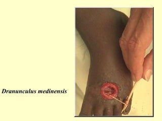 Dranunculus medinensis
 