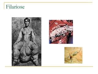 Filariose 