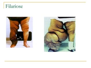 Filariose 