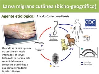 Larva migrans cutânea (bicho-geográfico)
Agente etiológico:          Ancylostoma brasiliensis




Quando as pessoas pisam
ou sentam em locais
infestados, as larvas
tratam de perfurar a pele
superficialmente e
começam a caminhada
que abrirá verdadeiros
túneis cutâneos.
 
