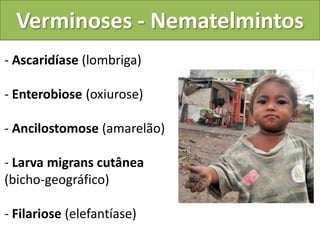 Verminoses - Nematelmintos
- Ascaridíase (lombriga)

- Enterobiose (oxiurose)

- Ancilostomose (amarelão)

- Larva migrans cutânea
(bicho-geográfico)

- Filariose (elefantíase)
 