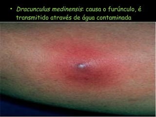 • Dracunculus medinensis: causa o furúnculo, é
transmitido através de água contaminada
 