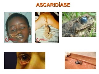 ASCARIDÍASEASCARIDÍASE
 